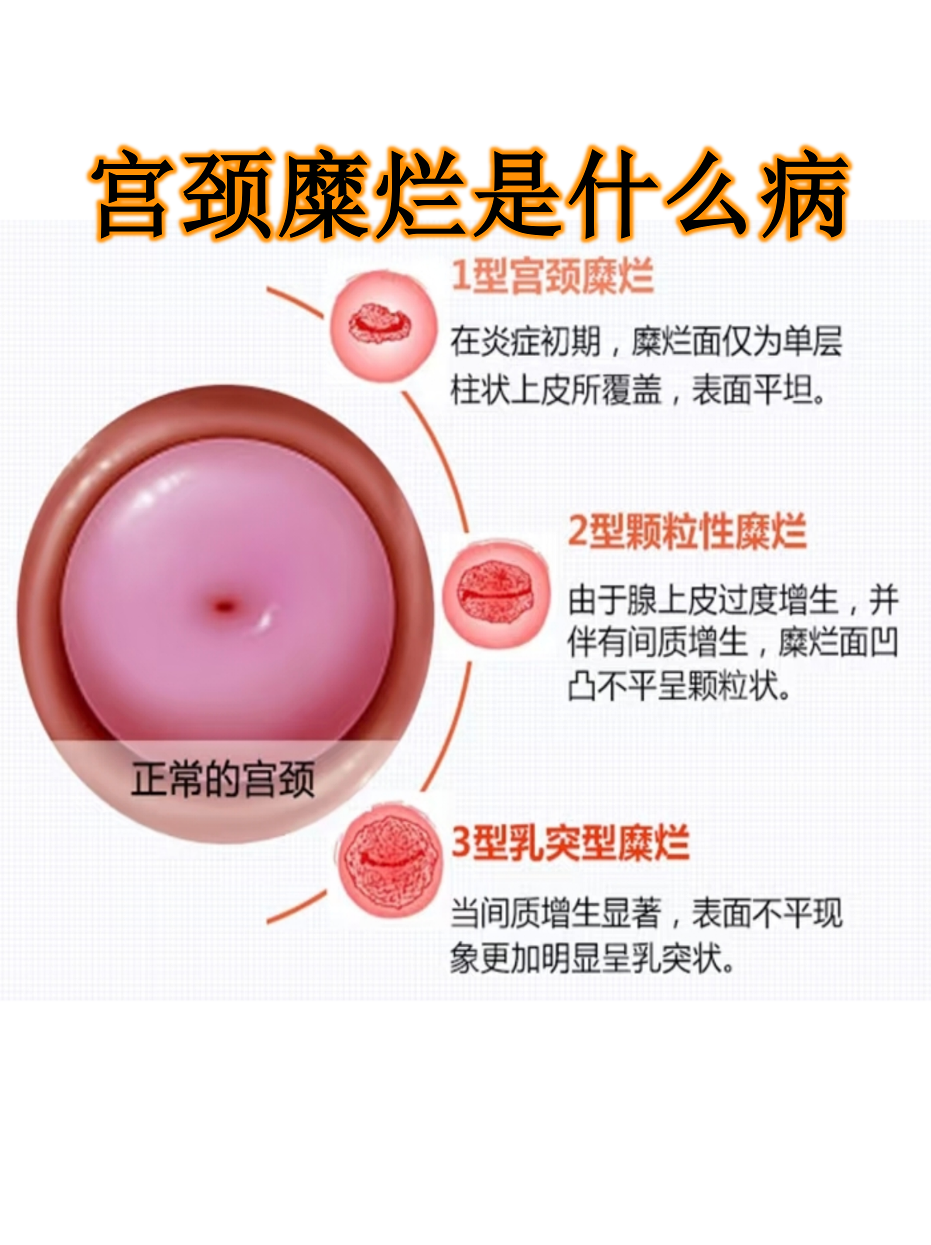宫颈糜烂听起来吓人,其实它根本不是疾病,而是宫颈