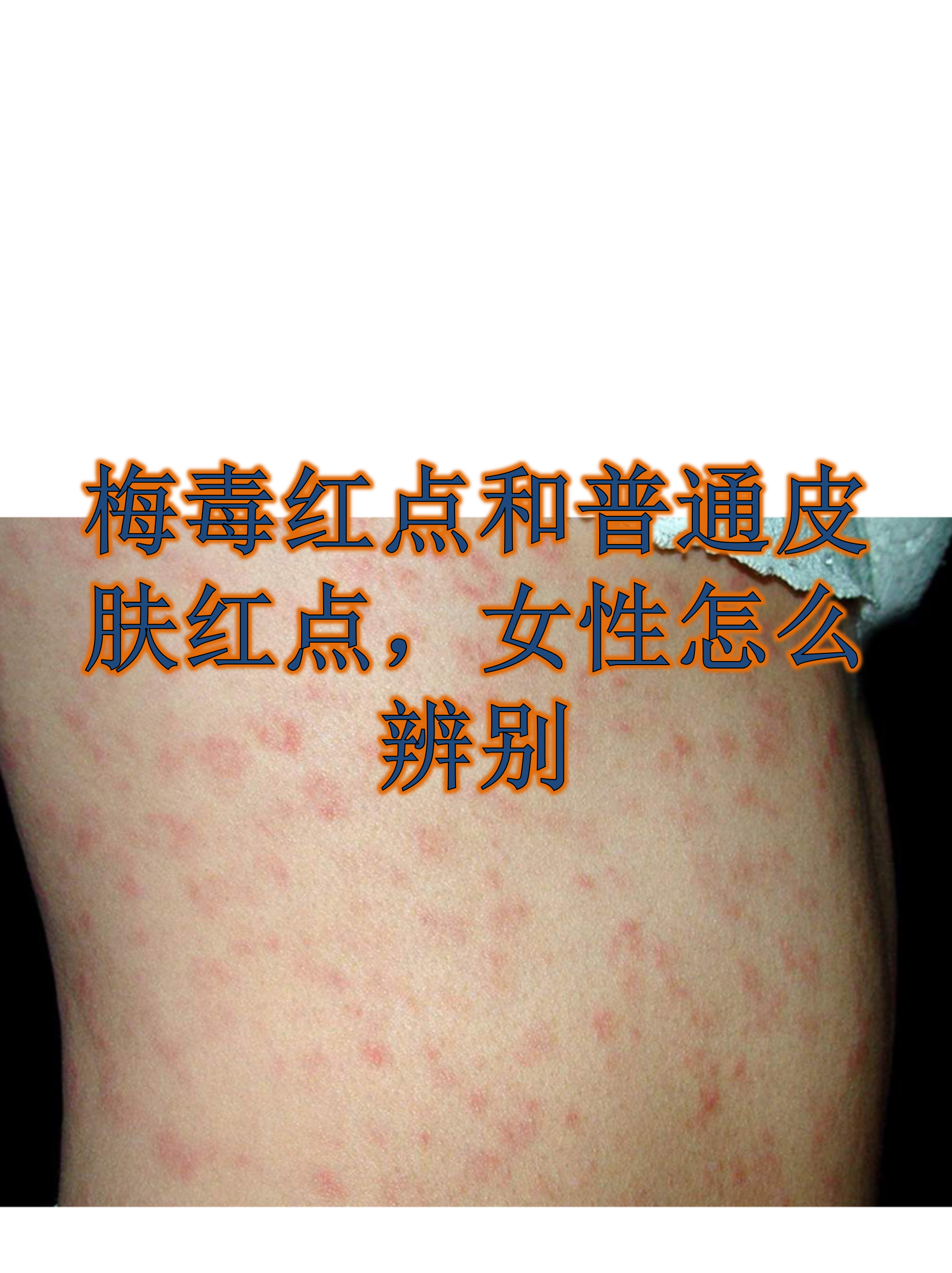 梅毒红点和普通皮肤红点,女性怎么辨别
