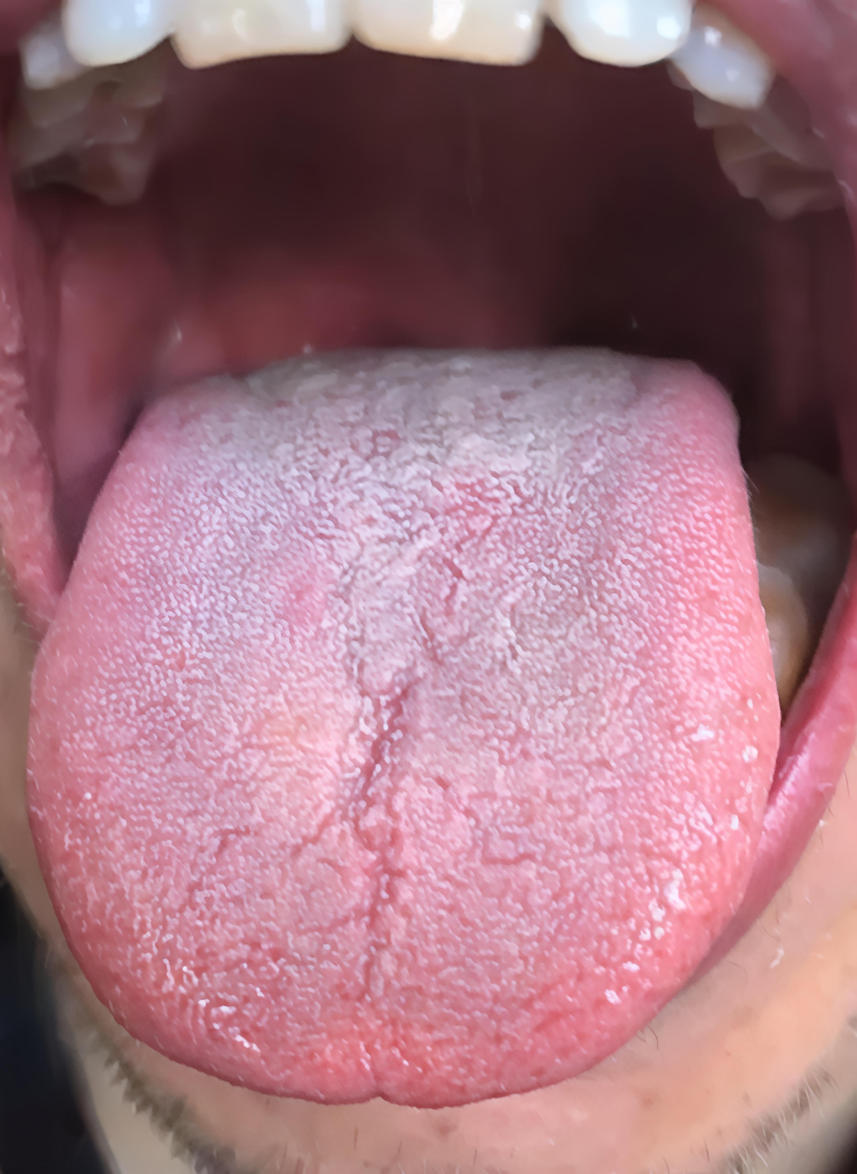 舌头尖,有裂纹是气阴两虚了,教你轻松破解难题