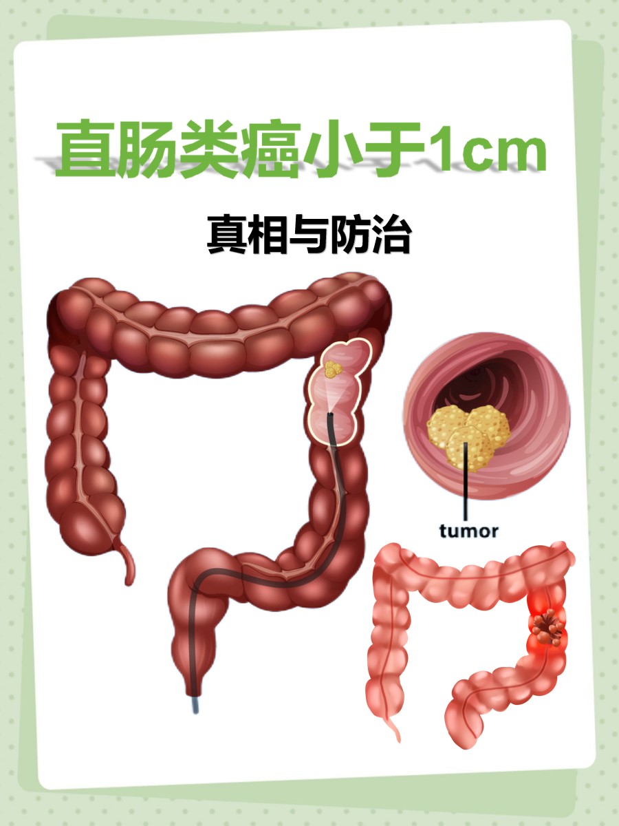 他急切地问:"医生,我听说直肠类癌小于1cm都是良性的,这是真的吗?