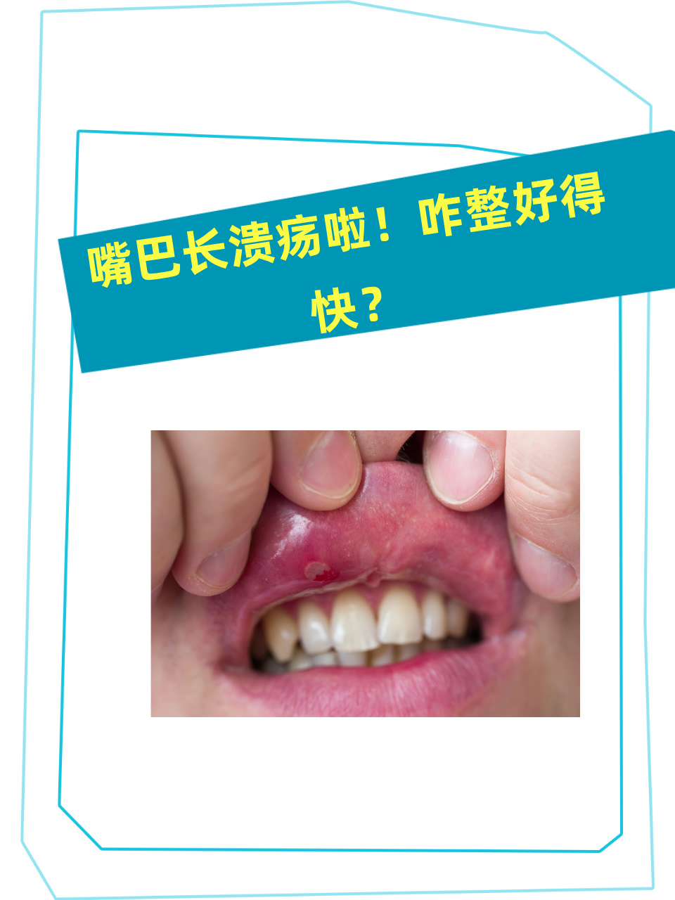 嘴巴长溃疡啦!咋整好得快?