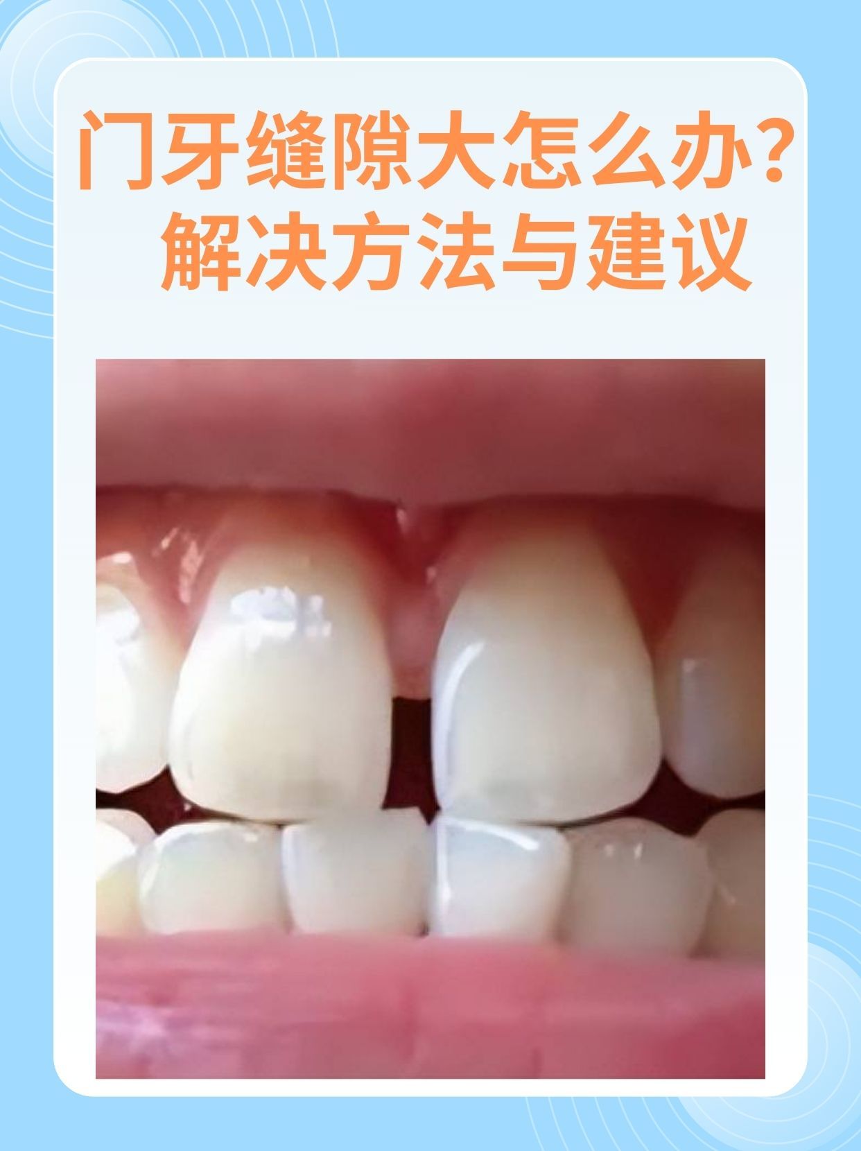 门牙缝隙大怎么办?