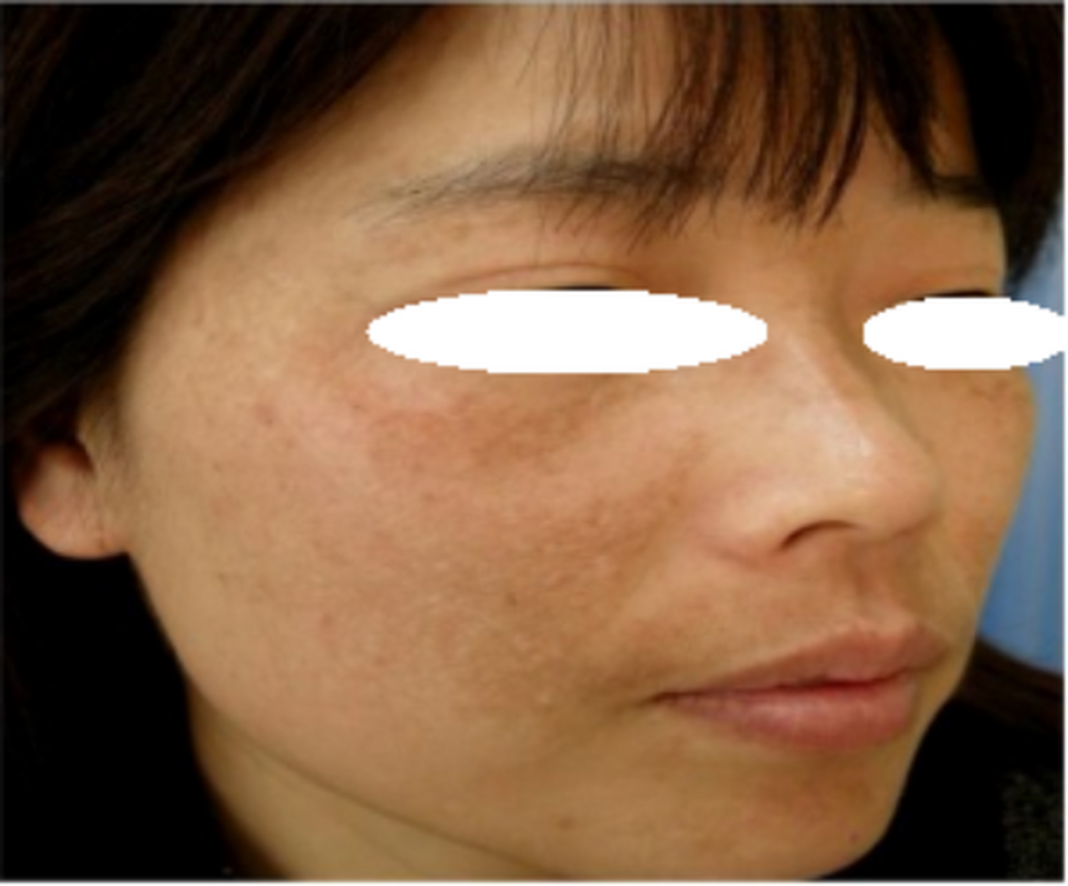 气滞血瘀型黄褐斑,千万别用外用的方法,白花钱罢了!