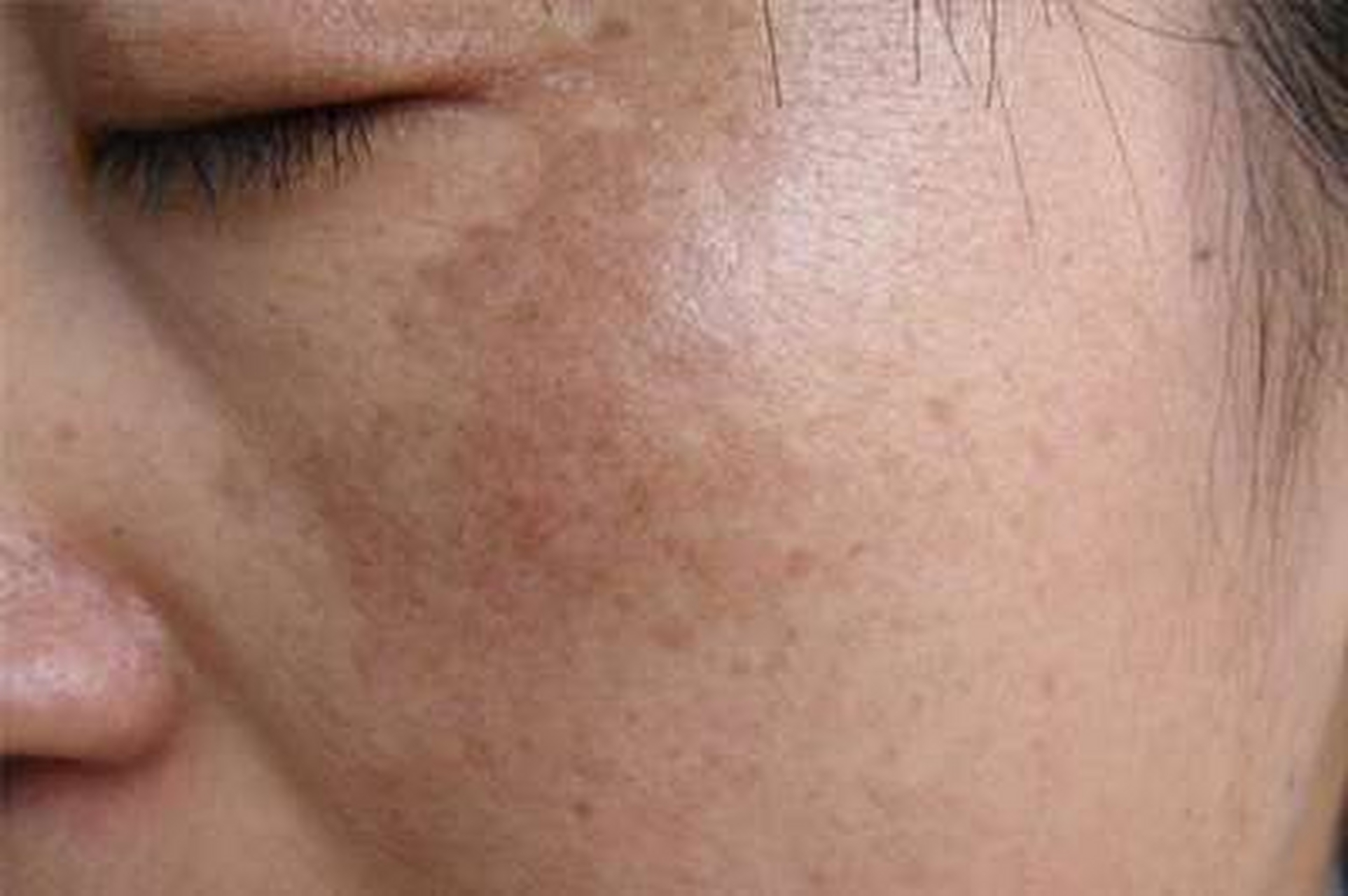 黄褐斑很多人都长,但是原因各有各的,不过在中医上,大部分来讲