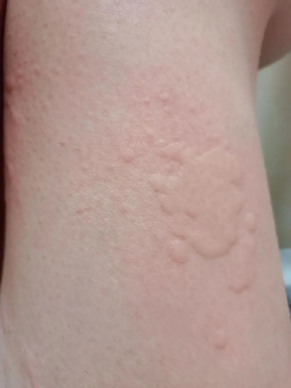 荨麻疹等级分级,你现在到了哪一级?