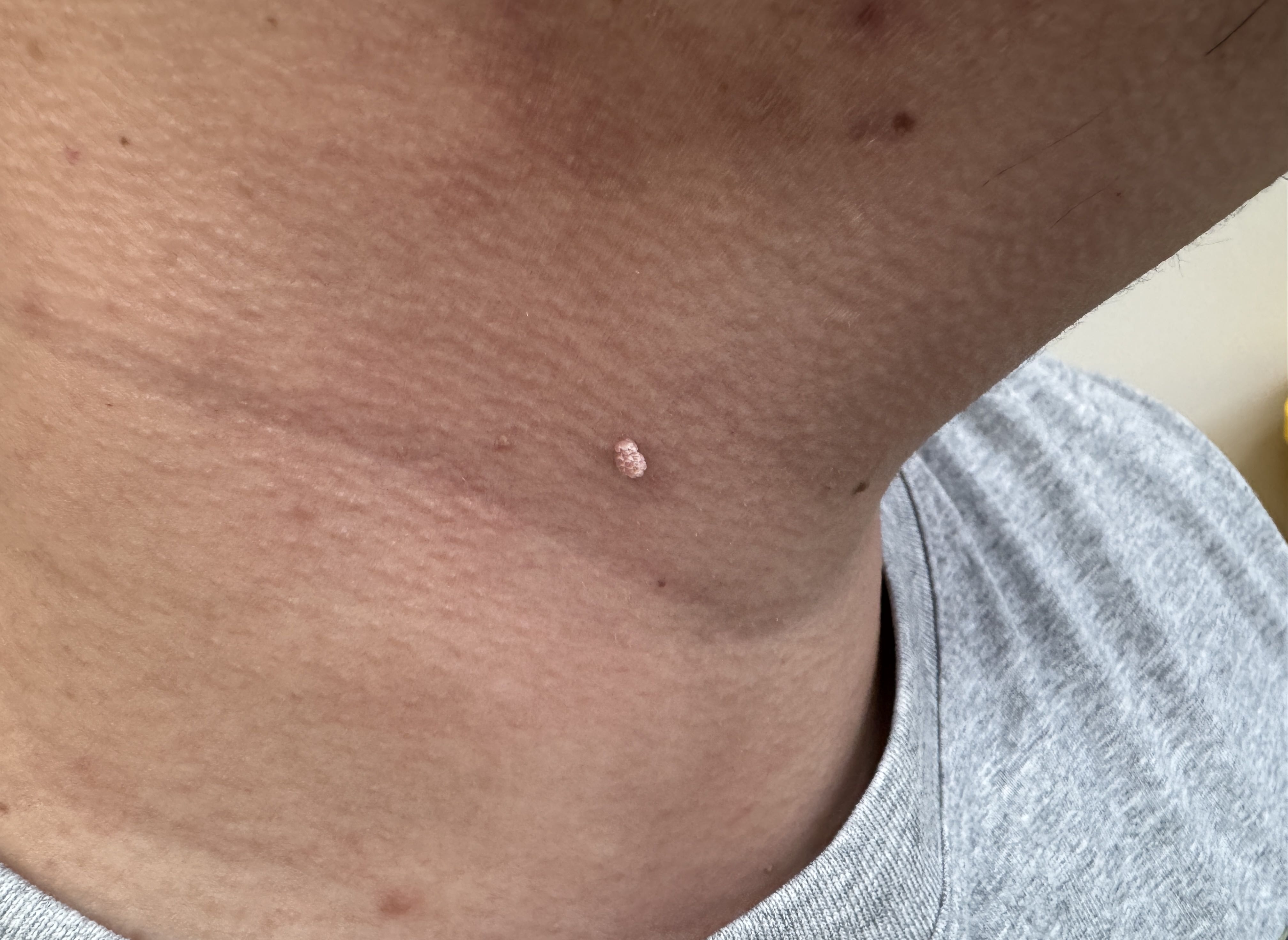 容易感染hpv的人!