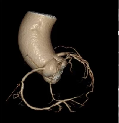 我们玄合门诊部近期长者看诊一位有胸痛史,就诊前一周,吸烟后胸痛发作