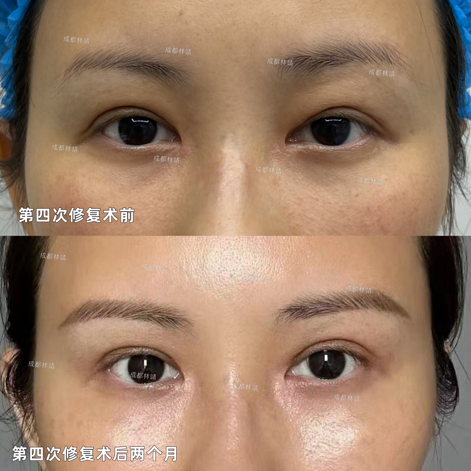 第四次修复,干瘪,缺皮,脂肪填充过多,看着简单其实