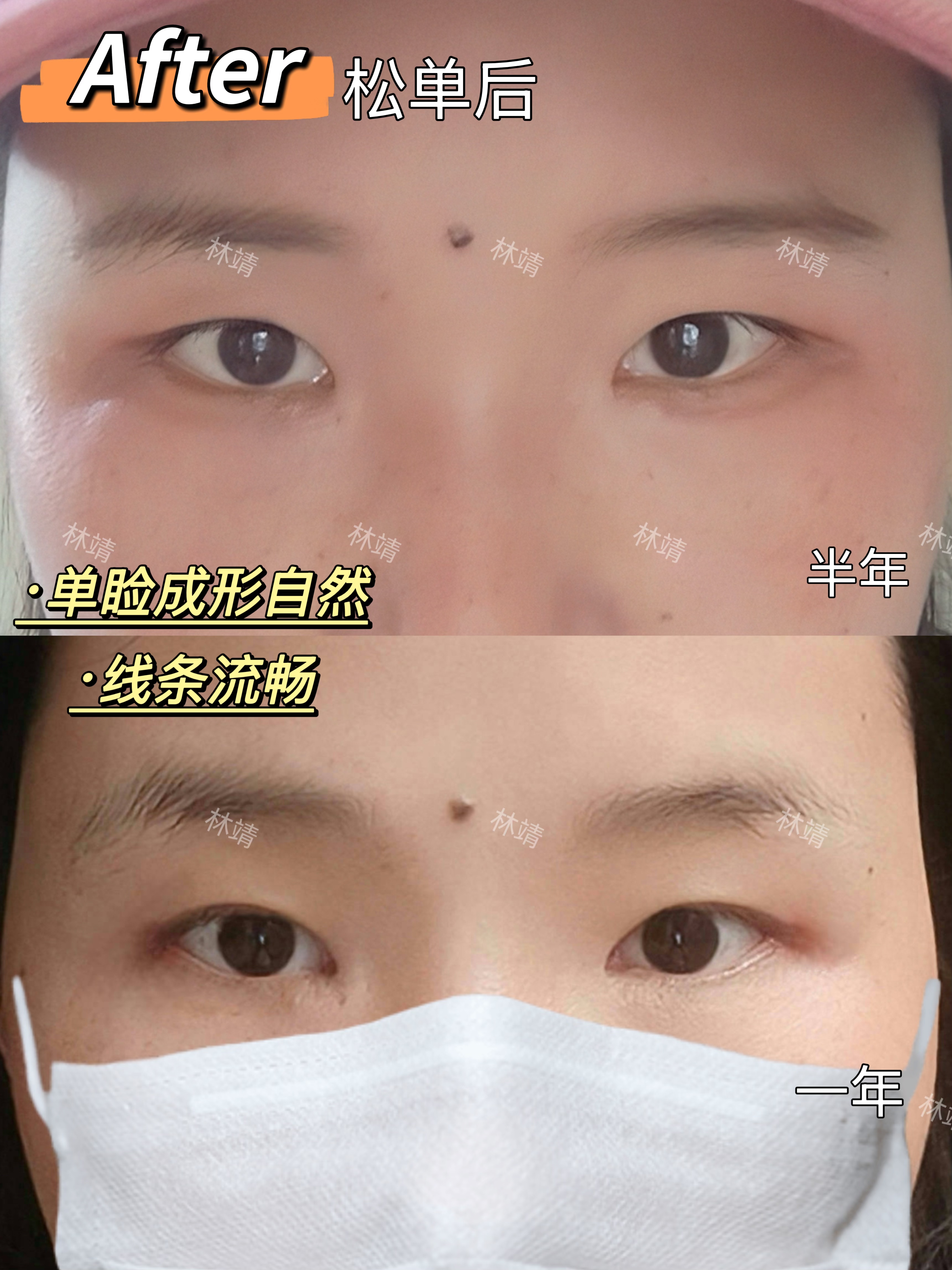 单眼皮成形术前后情况 小伙伴术前眼角偏圆,线条也很一般,有轻微大小