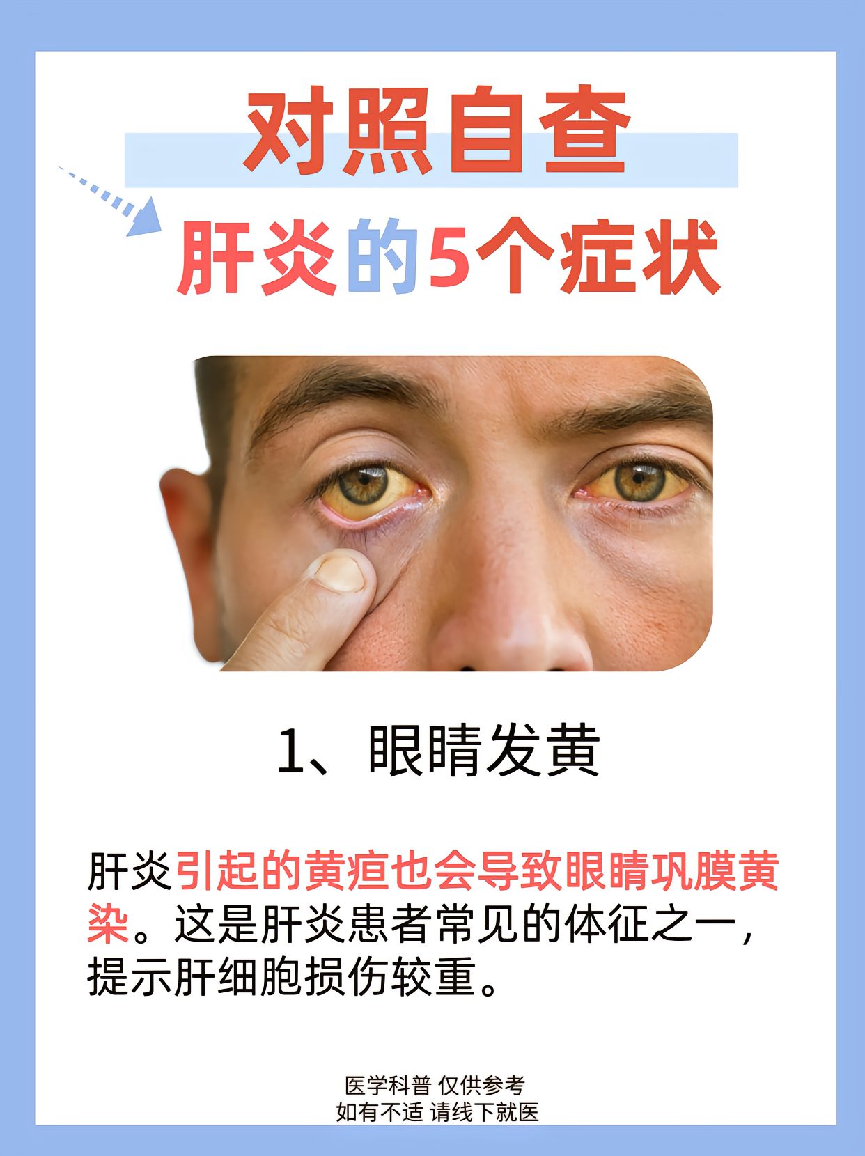 1,眼睛发黄:肝炎引起的黄疸也会导致眼睛巩膜黄染
