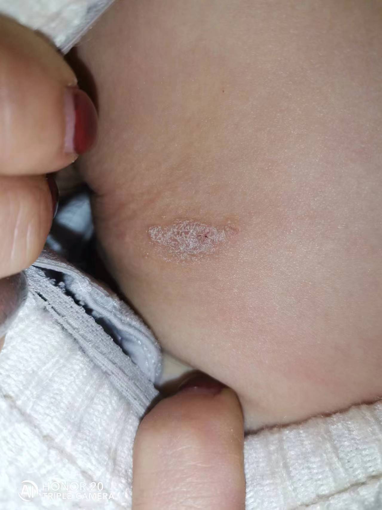 老婆脖子上长了这个东西,她说有点痒,有没有大神知道这是怎么回事?