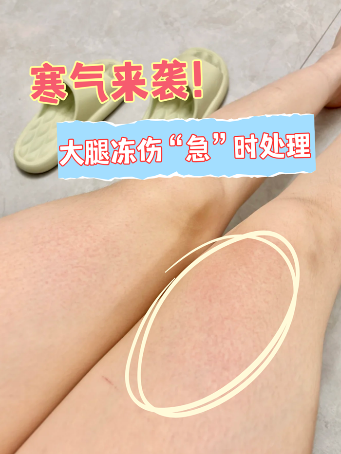 冻伤是由于寒冷潮湿作用引起的人体局部或全身