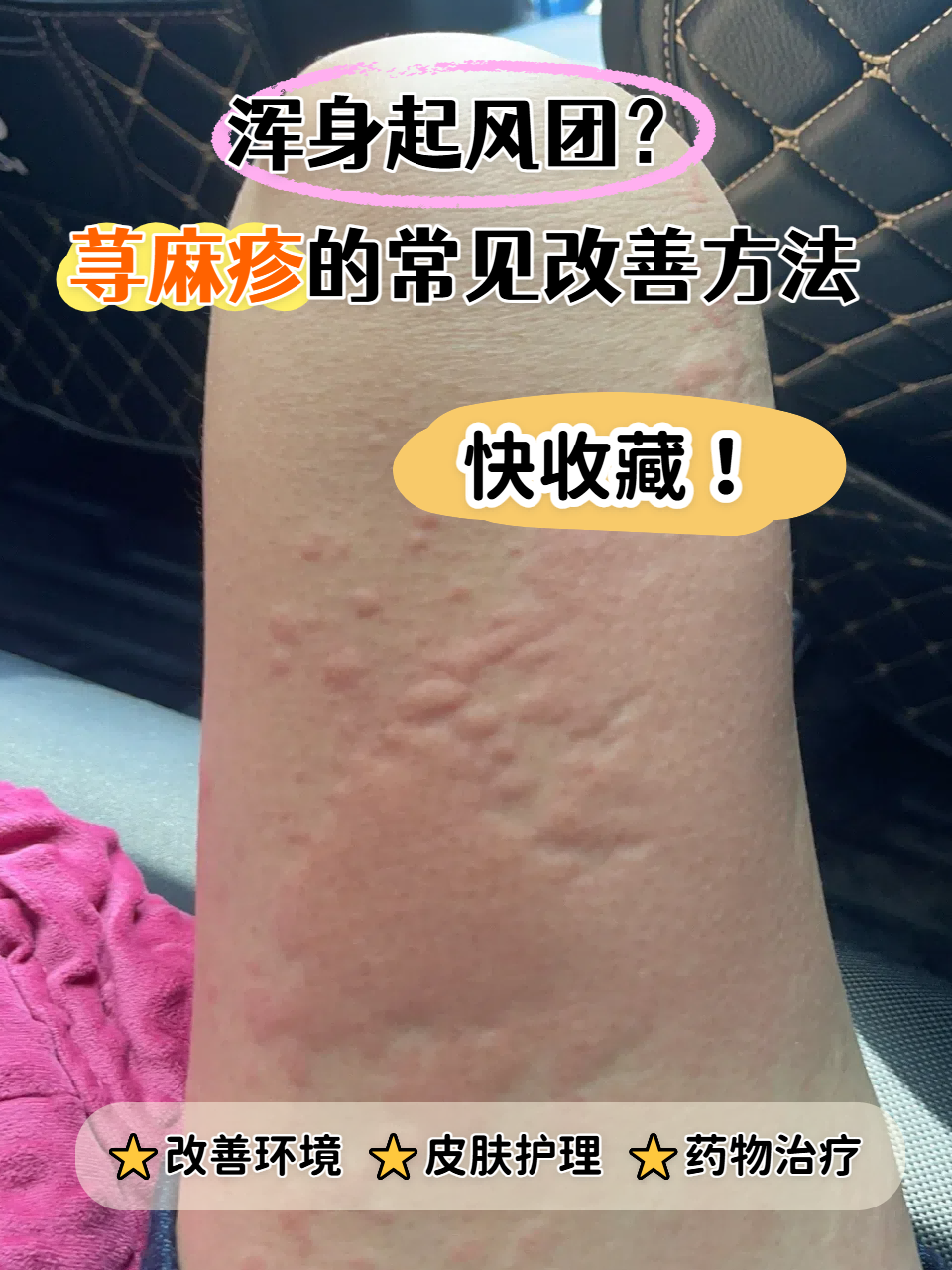 突然冒出大片红疙瘩,又痒又肿还越抓越多,这很可能是荨麻疹在捣乱!