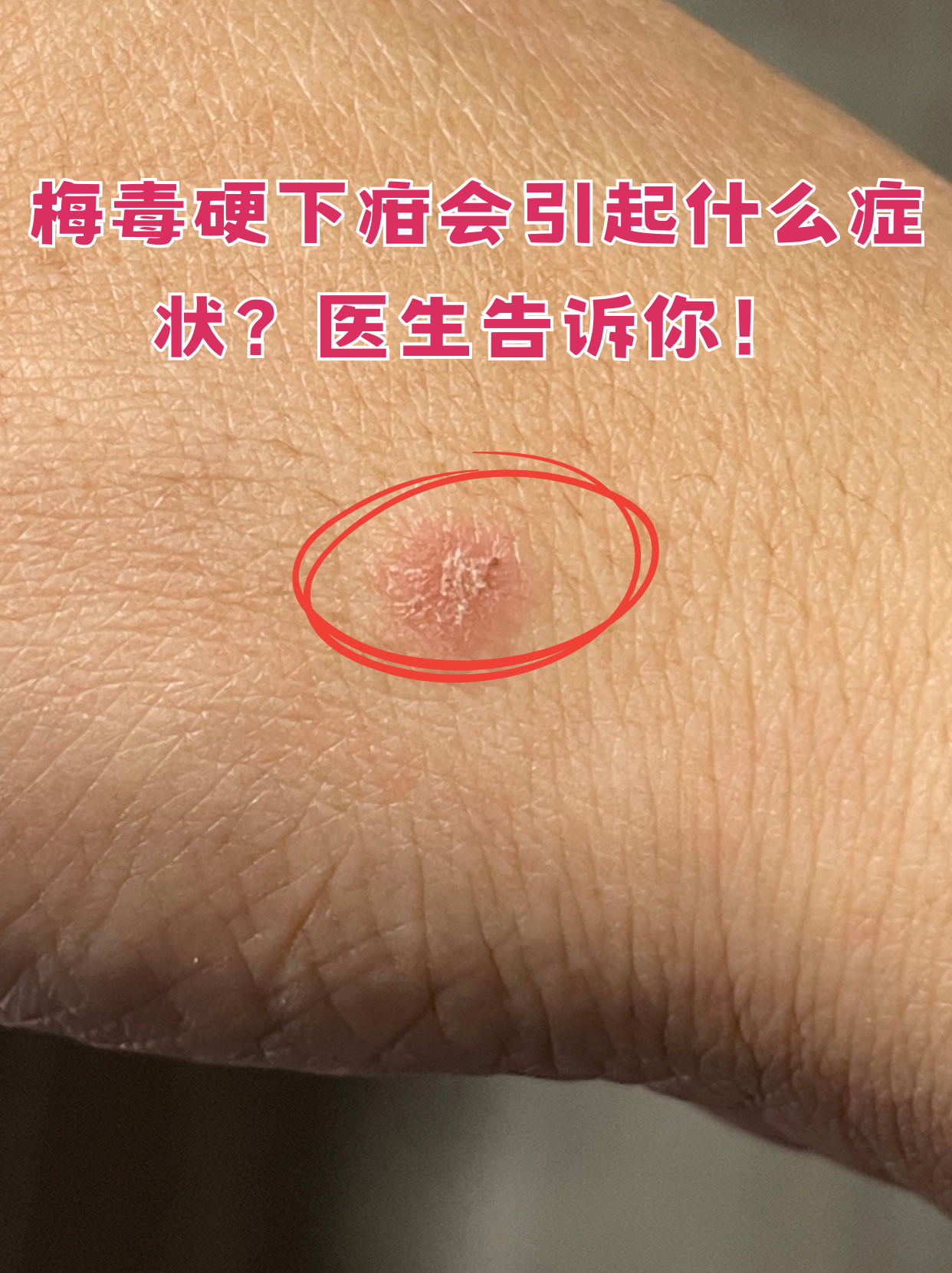 梅毒硬下疳是梅毒初期感染的典型表现,虽然不痛不痒但传染性极强