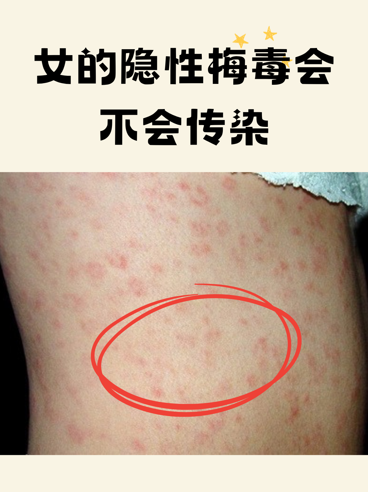 女的隐性梅毒会不会传染