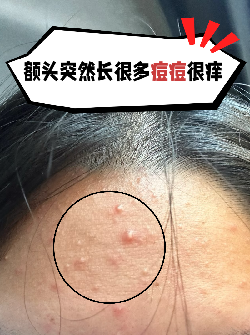 额头突然长很多痘痘很痒