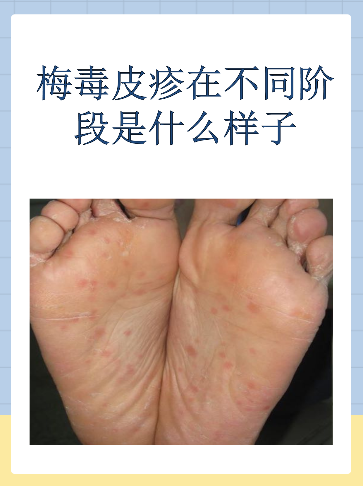 梅毒皮疹在不同阶段是什么样子