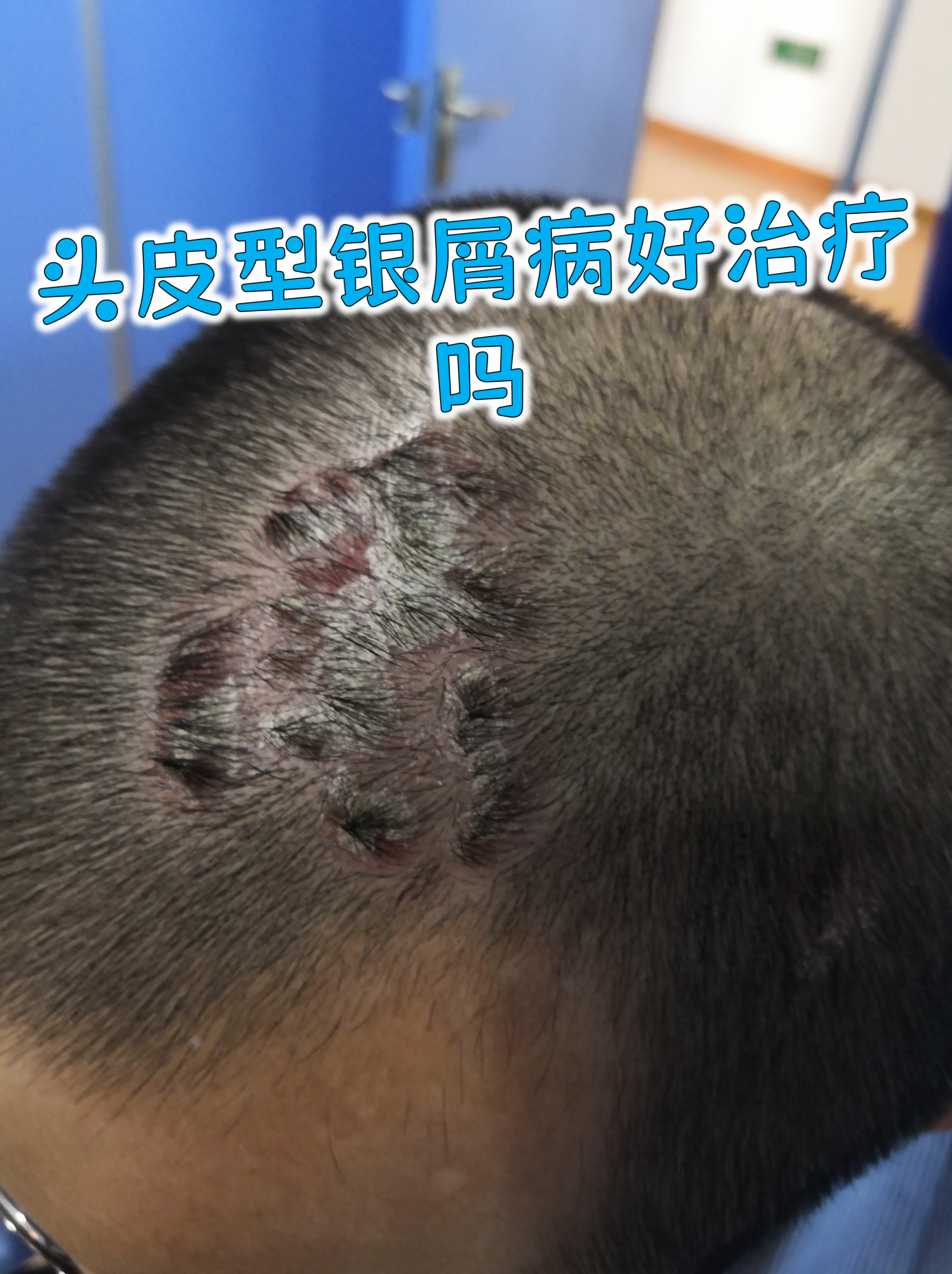 头皮型银屑病好治疗吗