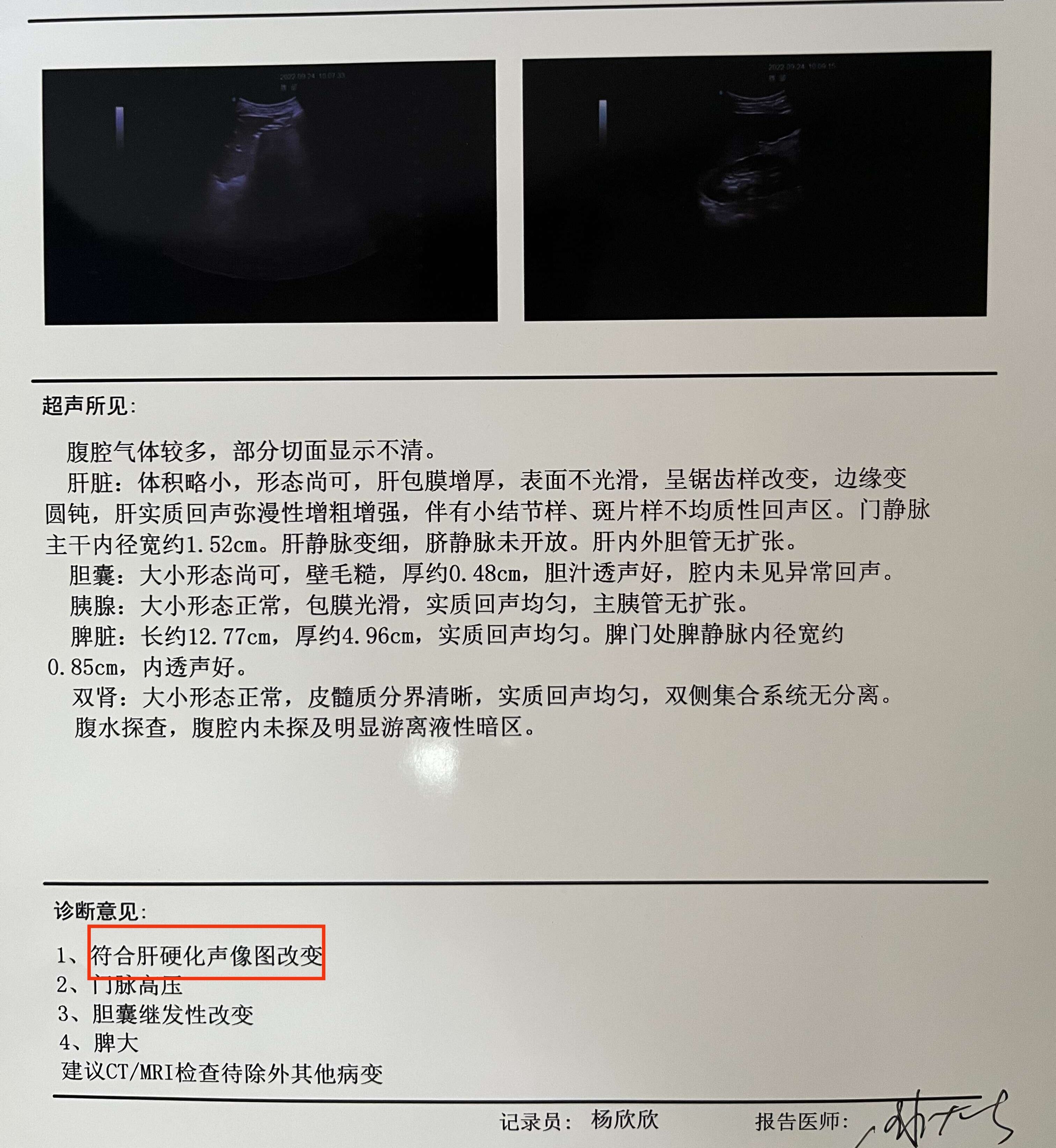 肝脏彩超出现6个问题,小心肝硬化!