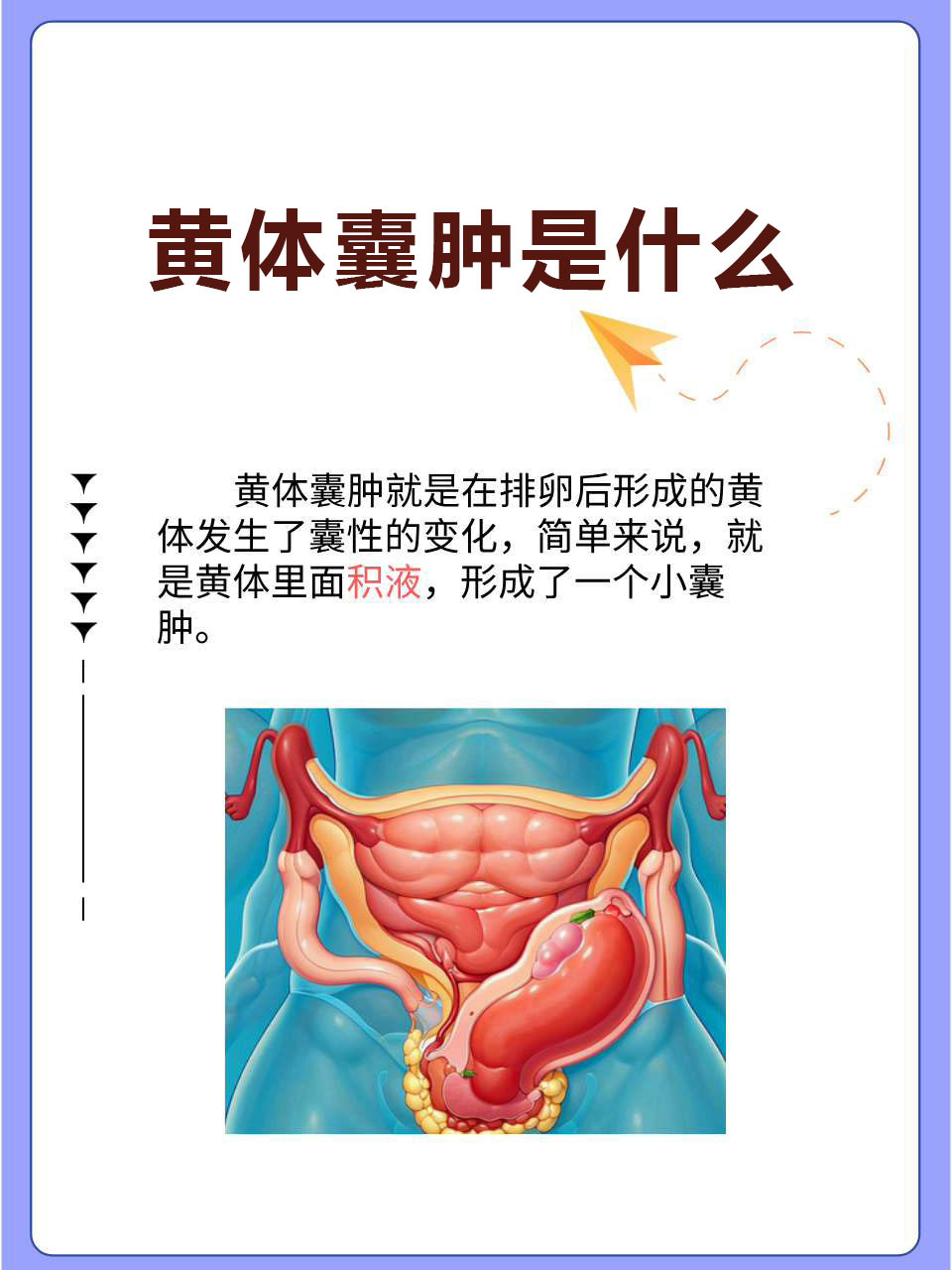 黄体囊肿图片