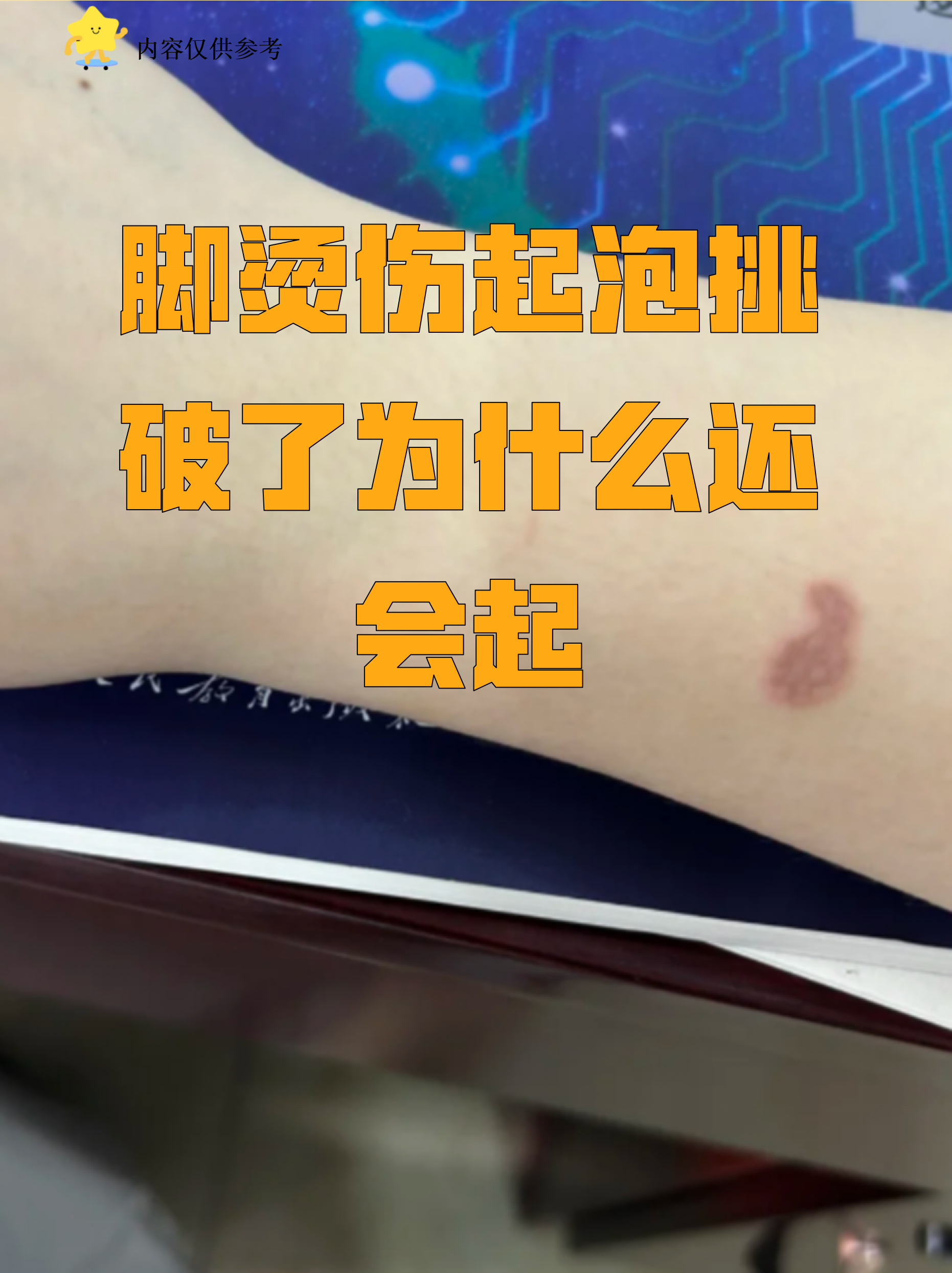 脚烫伤起泡挑破了为什么还会起