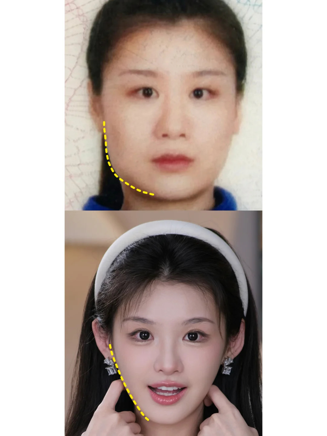 话···  1,这类人不do:太阳穴过宽,即便下半张脸变窄了,脸还是宽!