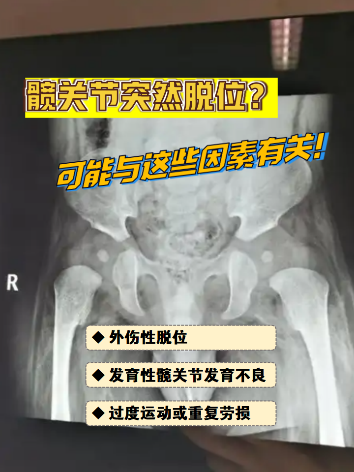 髋关节脱位带来的剧烈疼痛和活动受限让人措手不及