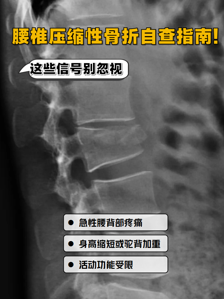 突然的腰背疼痛,活动受限,可能是腰椎压缩性骨折在