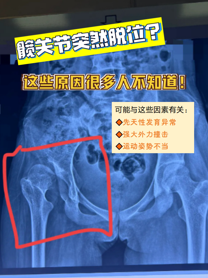 髋关节脱位带来的剧痛和活动受限让人措手不及