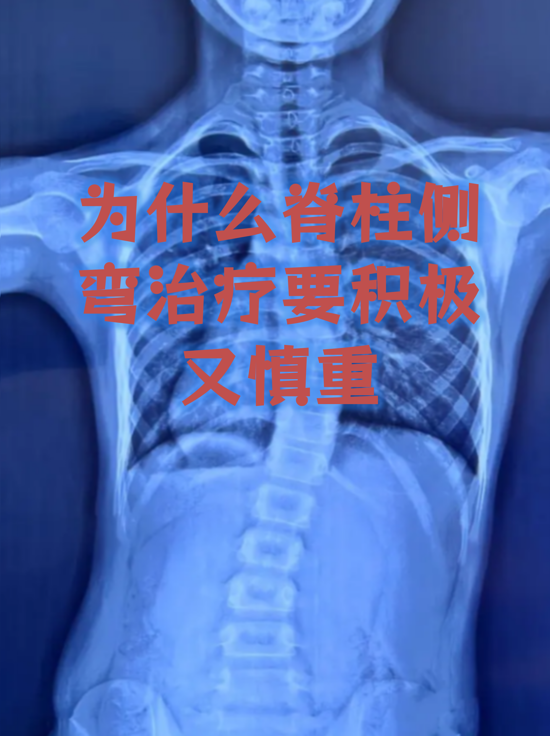 为什么脊柱侧弯