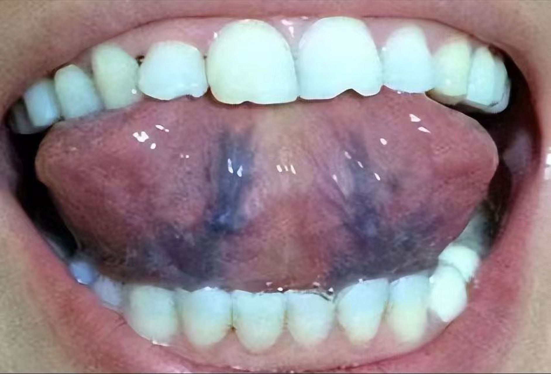 体内瘀血还不注意,自己看看舌下面的青筋粗成什么样子