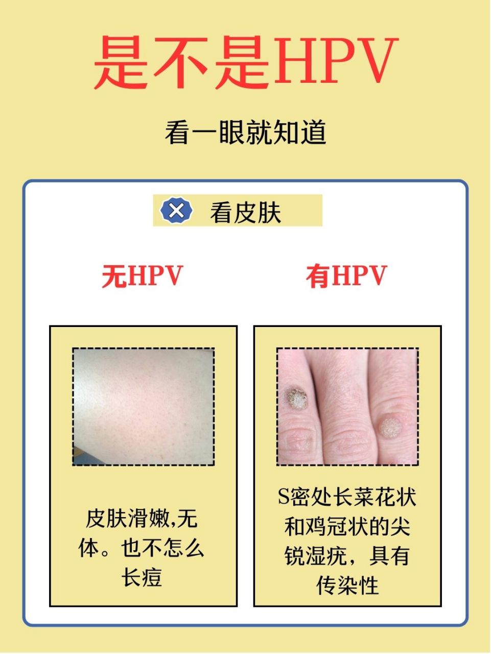 hpv表现图片