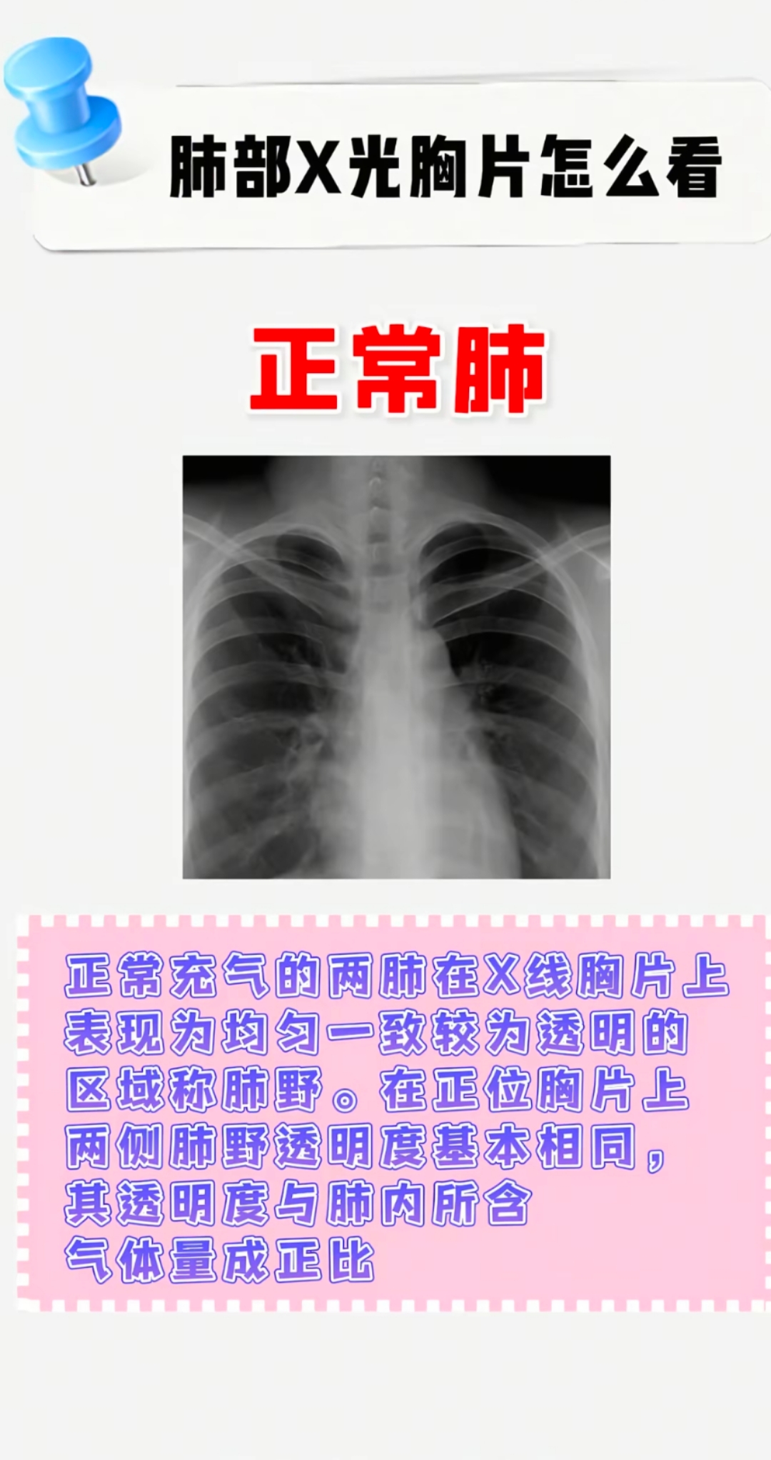 肺部x光胸片怎么看?