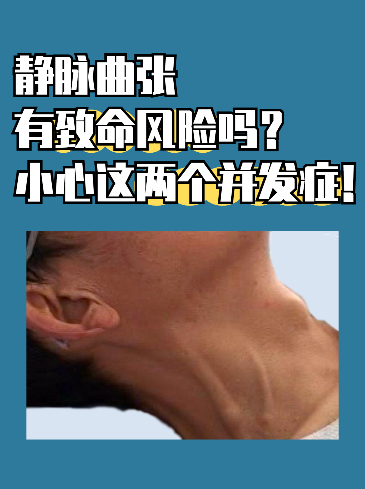 很多人以为静脉曲张不过是腿部血管凸起,影响美观,殊不知它暗藏致命