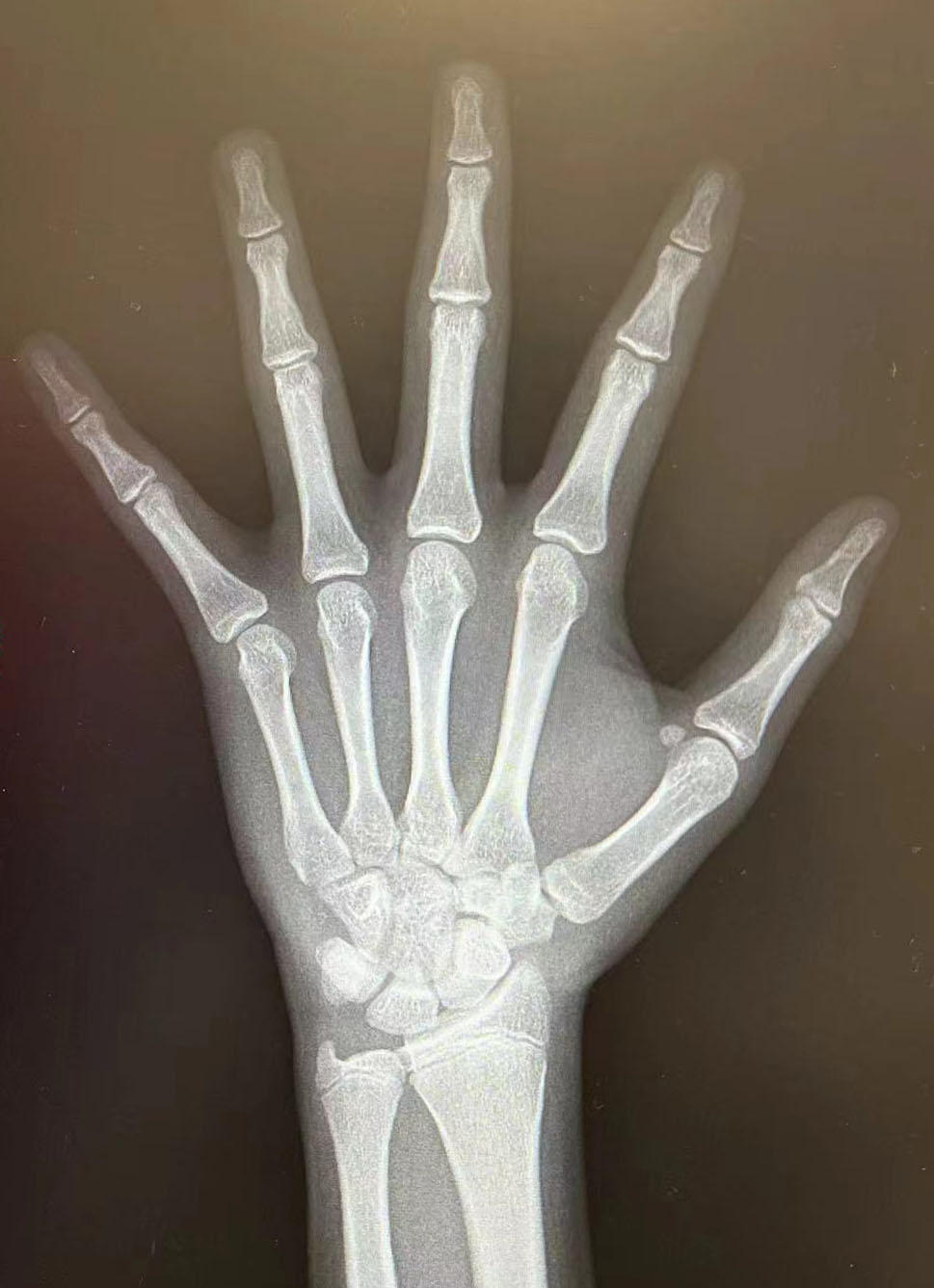 15岁还要看看骨龄,还有没有空间呢