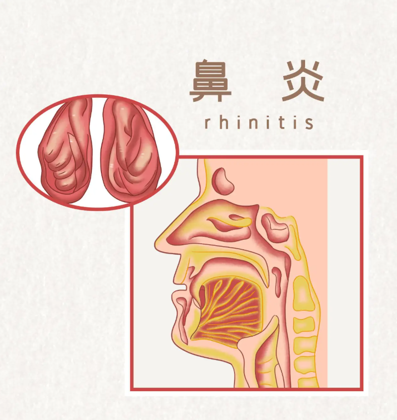 鼻炎反复发作?问题或许不在鼻子!中医教你找根源,调好它轻松缓解!