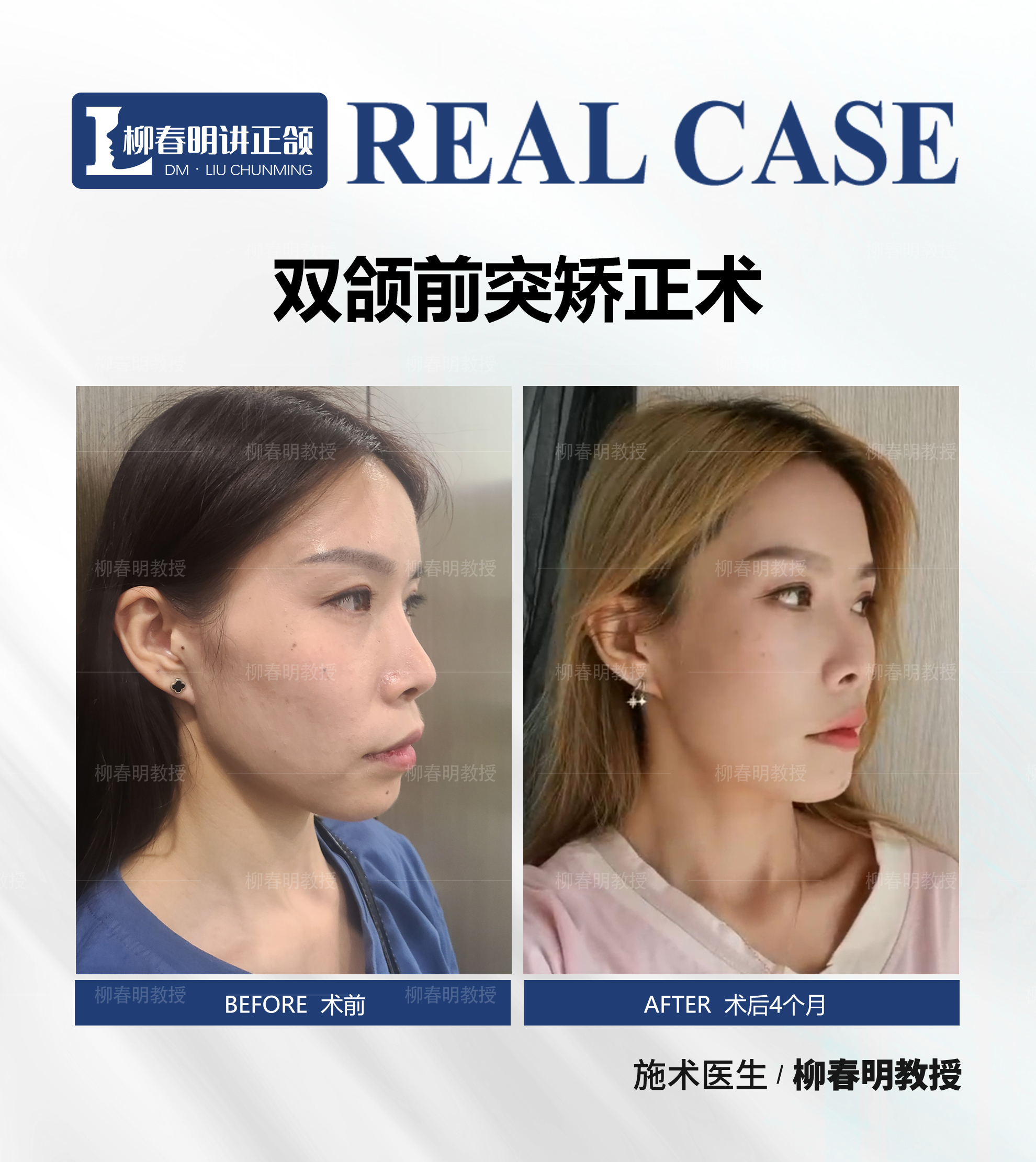 嘴严重 【方案】双颌前突矫正 【术后4个月】凸嘴消失,鼻唇颏线条流畅