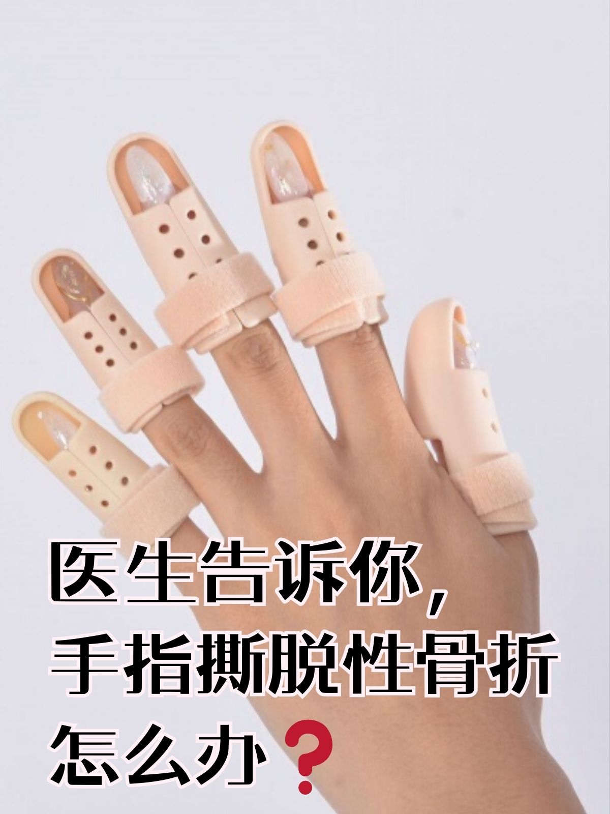 医生告诉你,手指撕脱性骨折怎么办 在日常生活中,手指撕脱性骨折是一