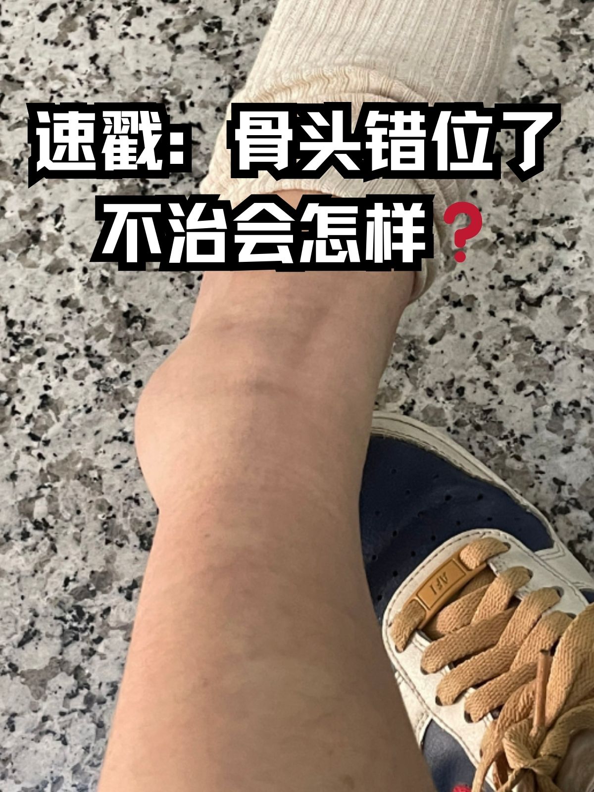 速戳:骨头错位了不治会怎样 在日常生活中可能会因为各种原因遭遇意外