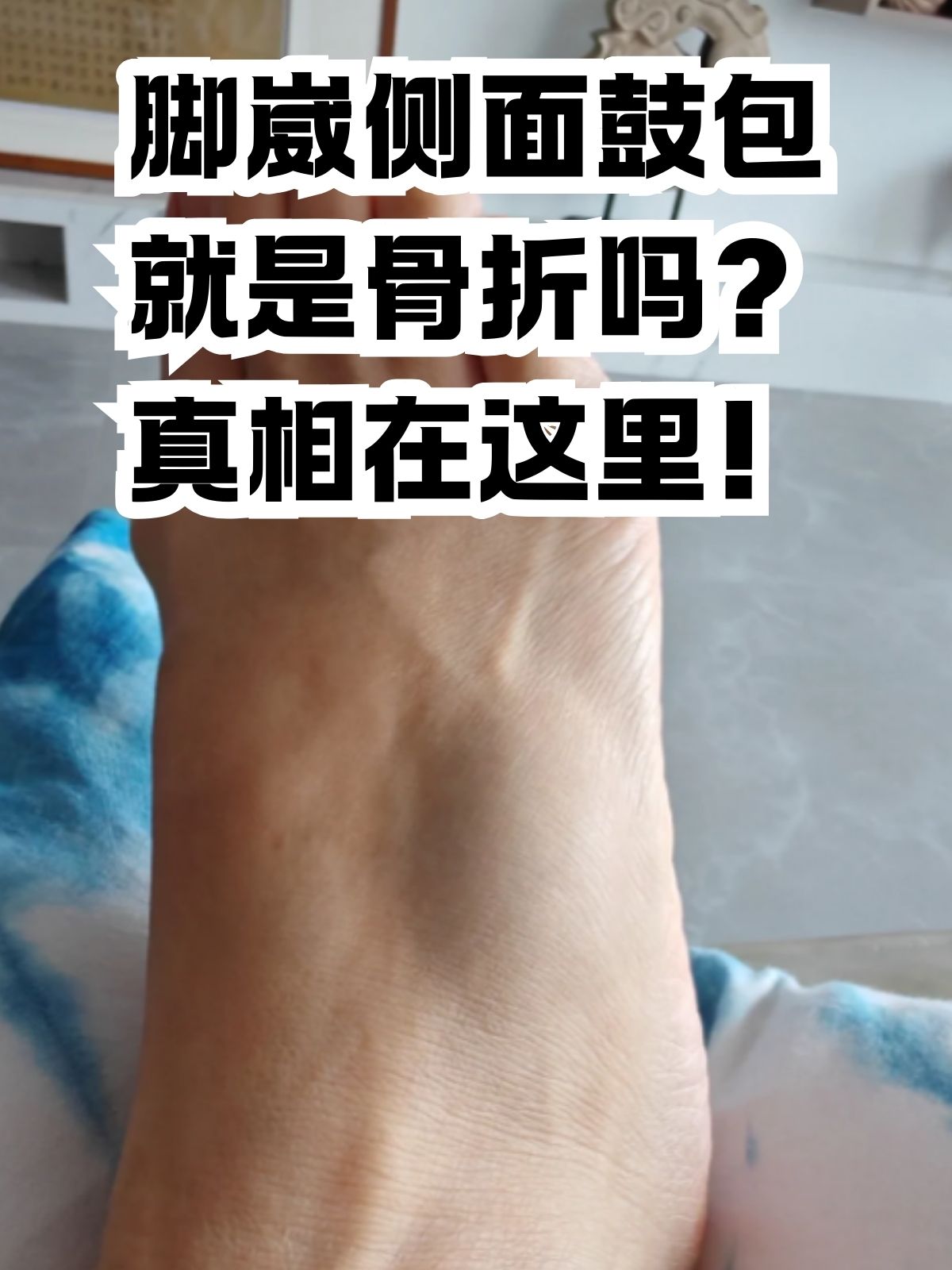 脚崴侧面鼓包就是骨折吗?真相在这里!