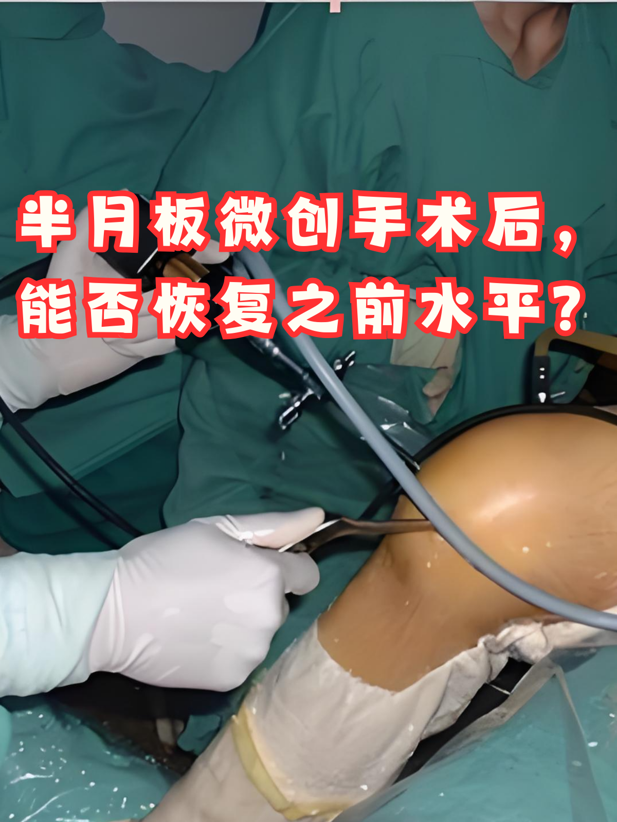 半月板微创手术是治疗半月板损伤的有效方法之一,这种手术具有创伤小