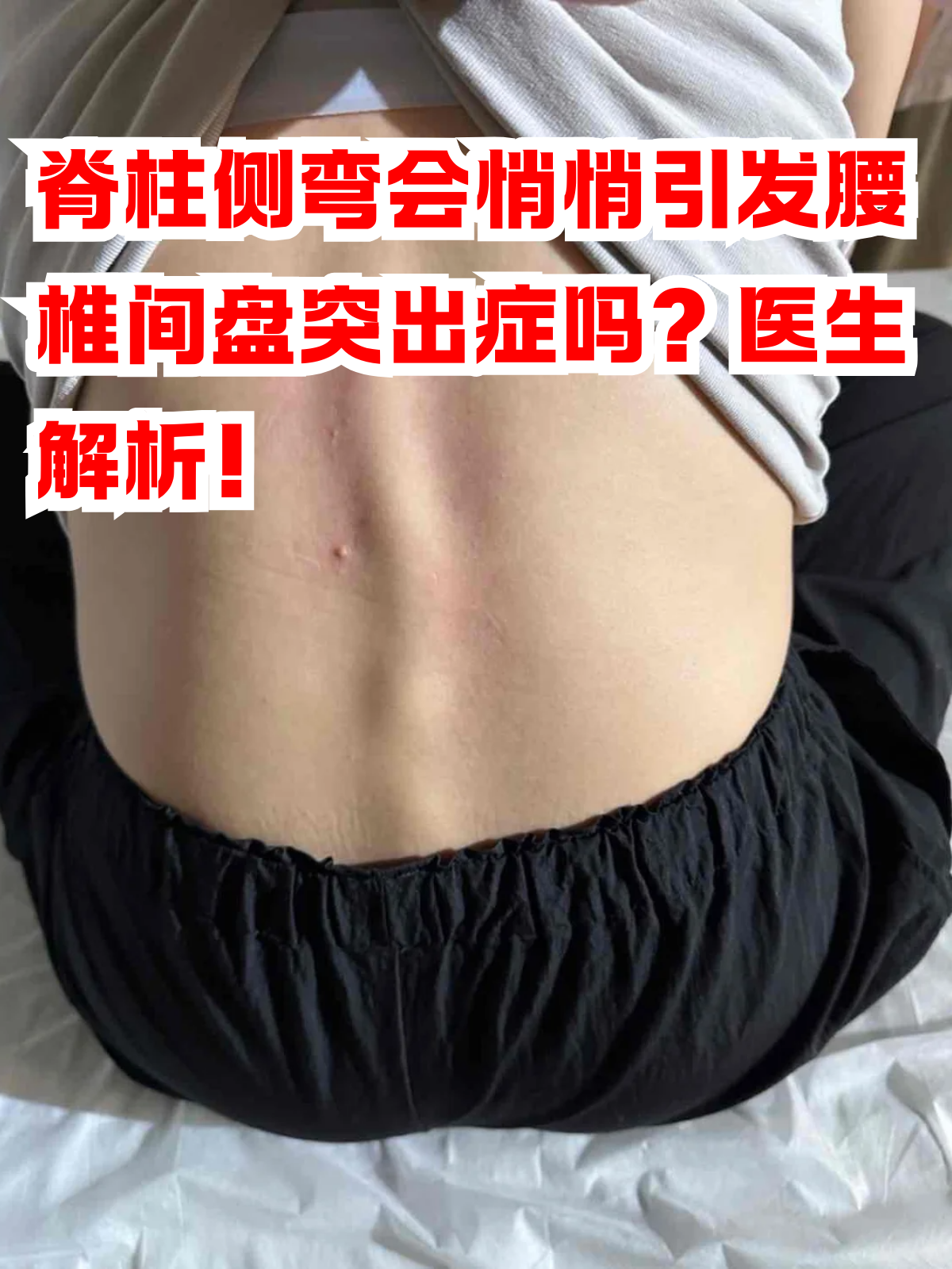 脊柱侧弯有可能导致腰椎间盘突出症