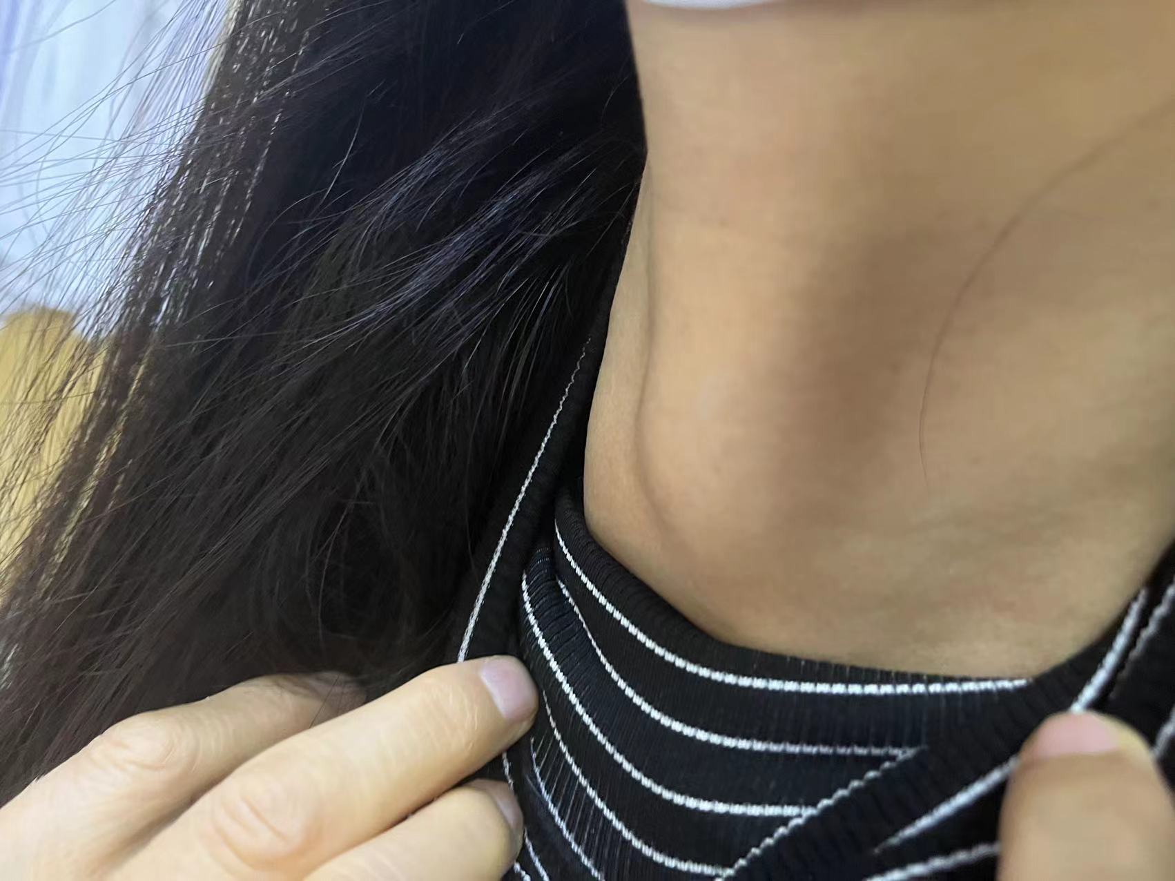 【甲亢等同于大脖子病吗?二者之间有什么关系?】 一,定义不同 1