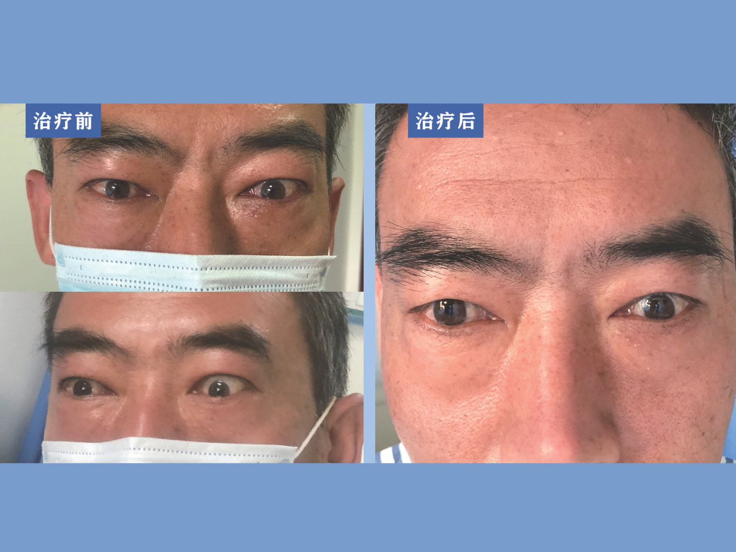 【甲亢突眼做眼眶减压术的方式有哪些?】 1