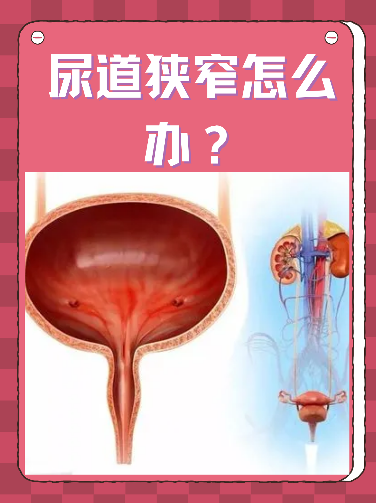 尿道狭窄是一种常见的泌尿系统疾病,主要表现为排尿困难,尿线变细