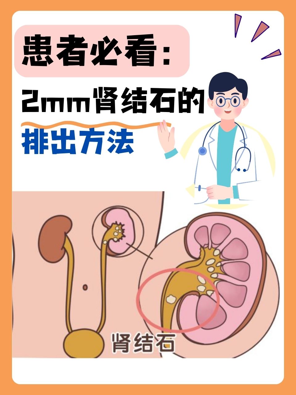 患者必看 2mm肾结石的排出方法  在日常生活中