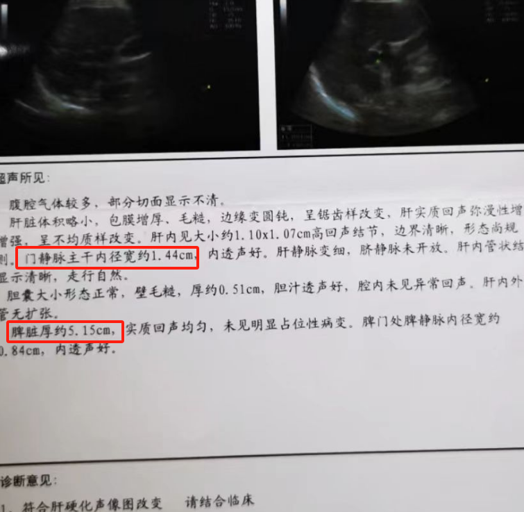 肝硬化彩超报告! 肝实质回声增粗增强,门静脉1