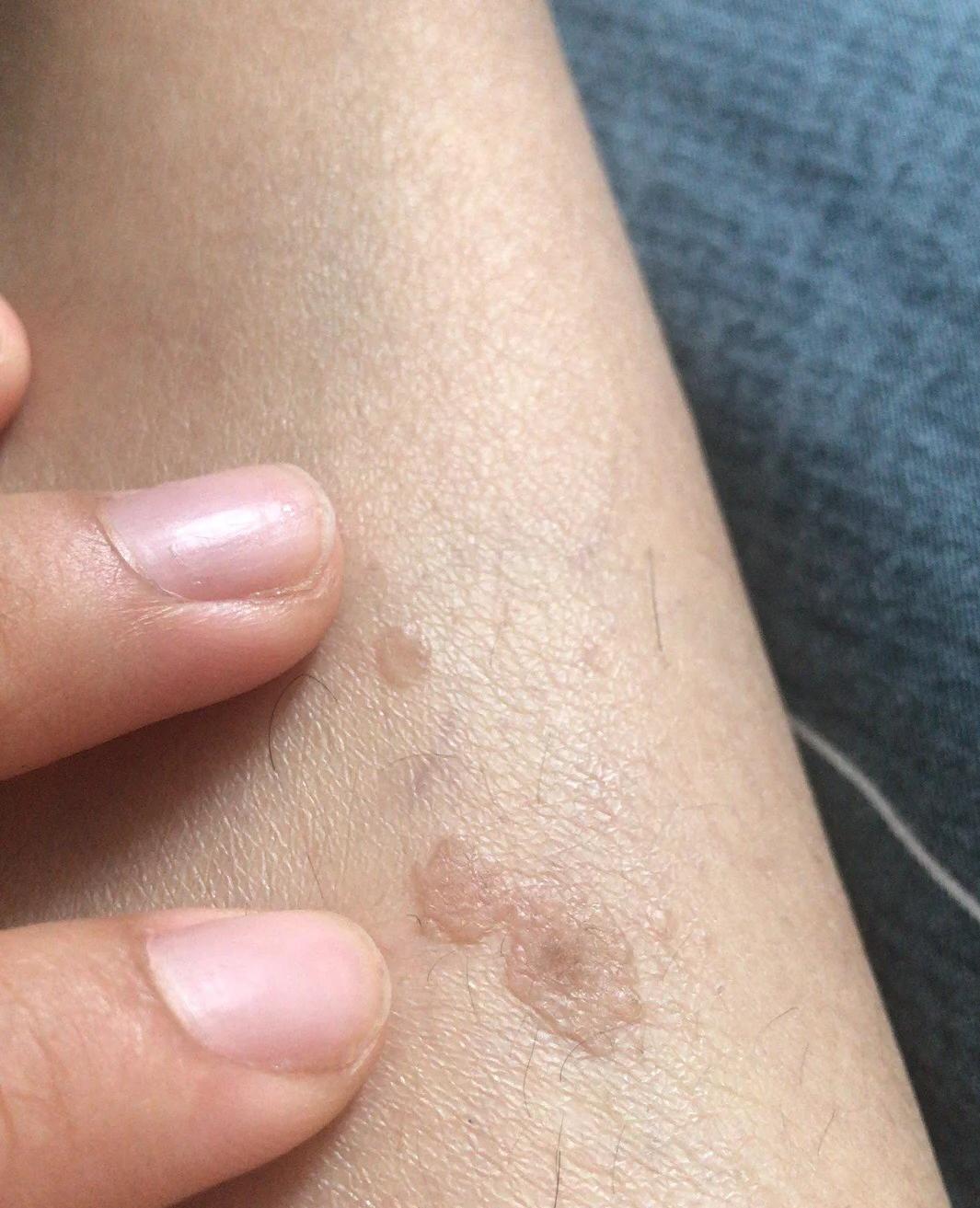 男人感染hpv,2个表现,瞒不住