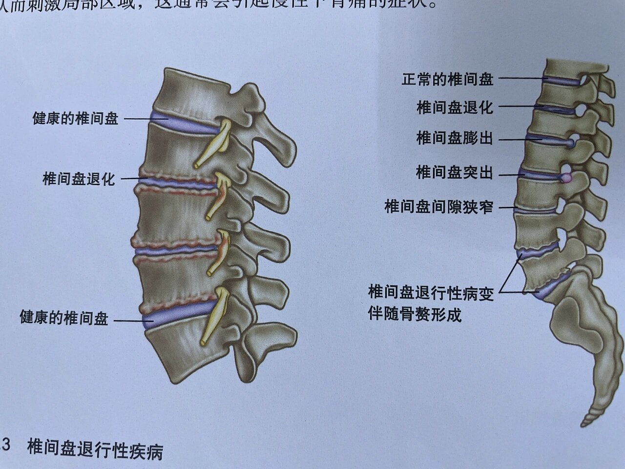 治疗分为两大类  椎管狭窄是一种常见的脊柱问题