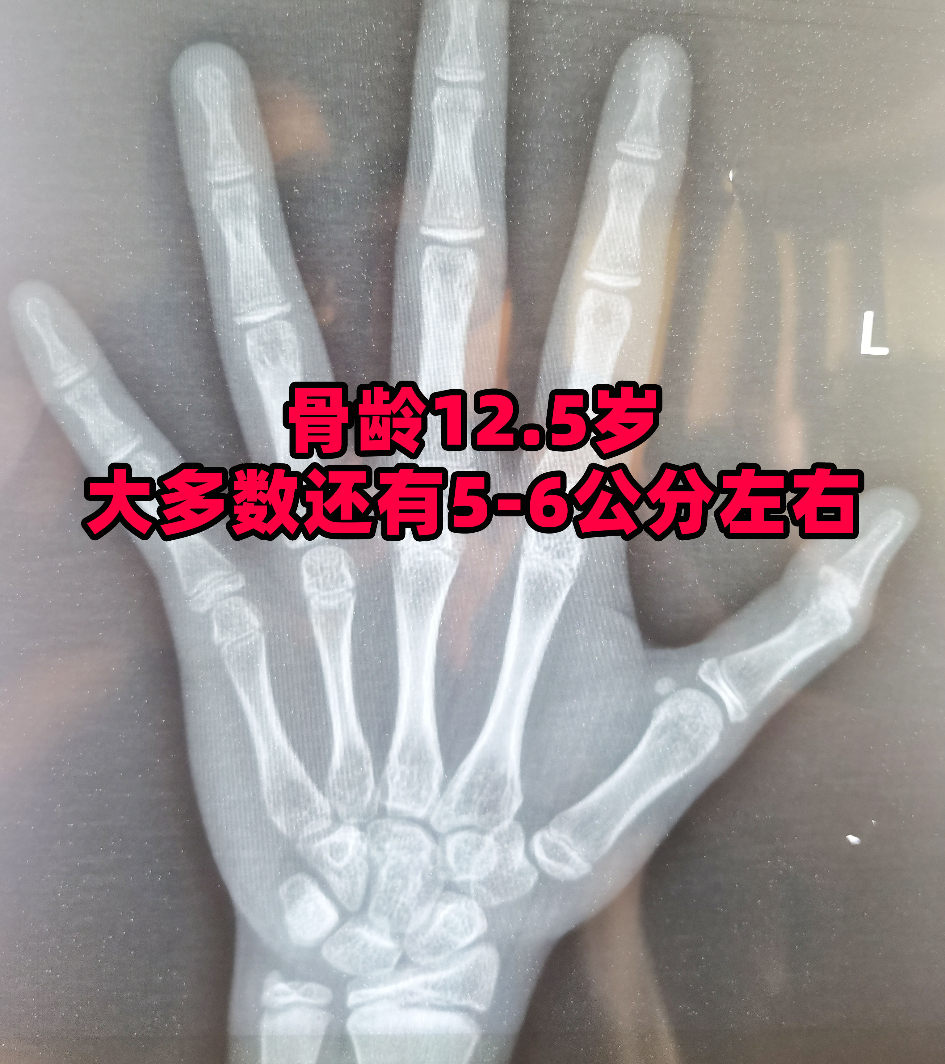 大数据统计发现,当女孩骨龄到12